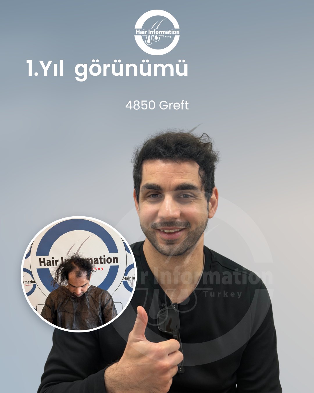 Saç ekimi öncesi ve sonrası – 1. yıl, 4.850 greft – Hair Information Clinic İzmir