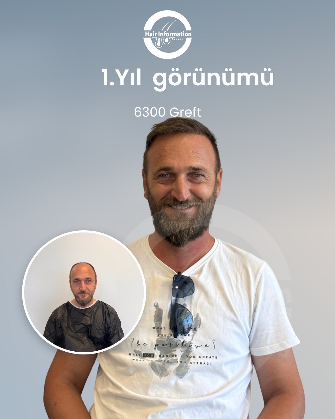 Saç ekimi öncesi ve sonrası – 1. yıl, 6.300 greft – Hair Information Clinic İzmir