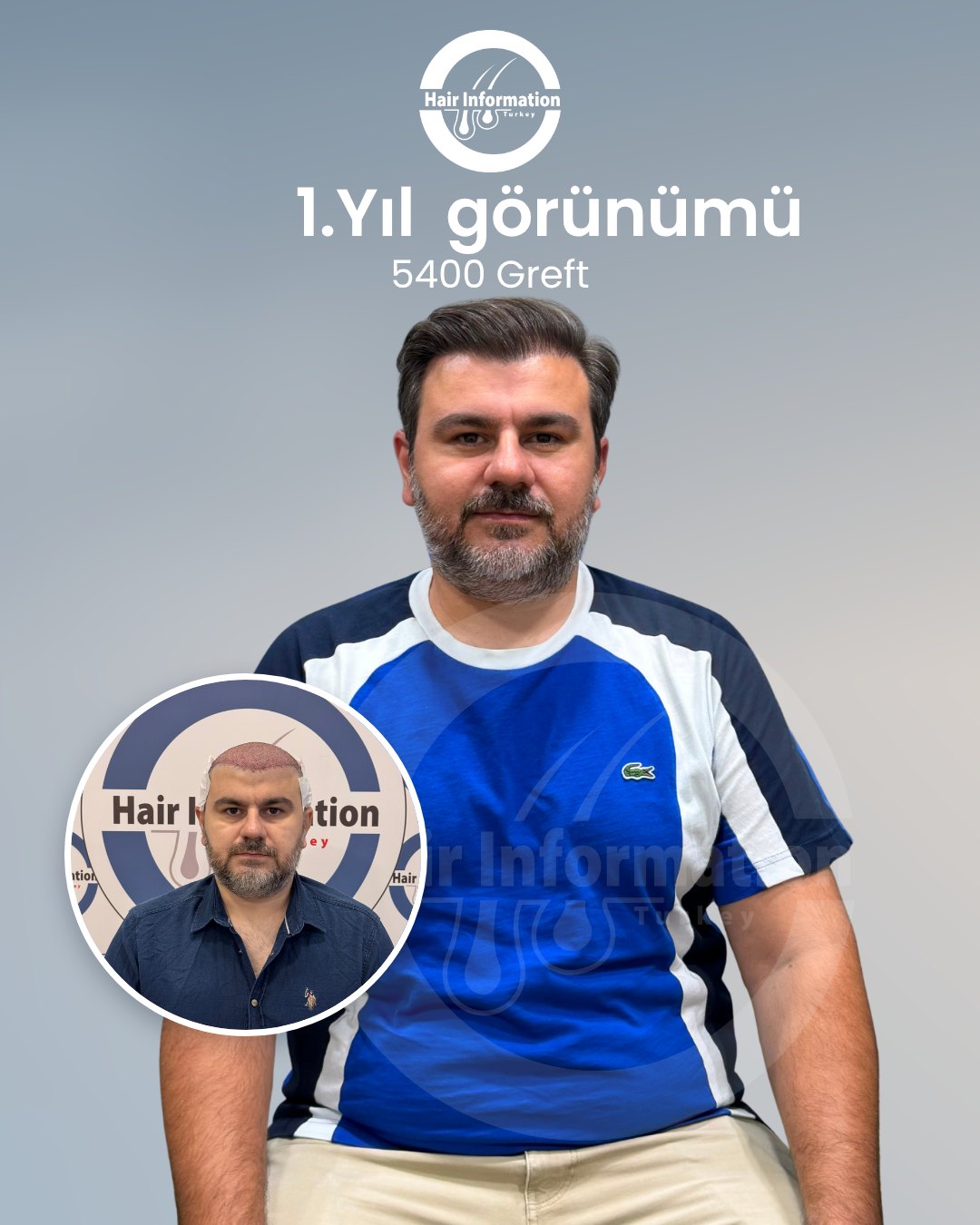 Saç ekimi öncesi ve sonrası – 1. yıl, 5.400 greft – Hair Information Clinic İzmir