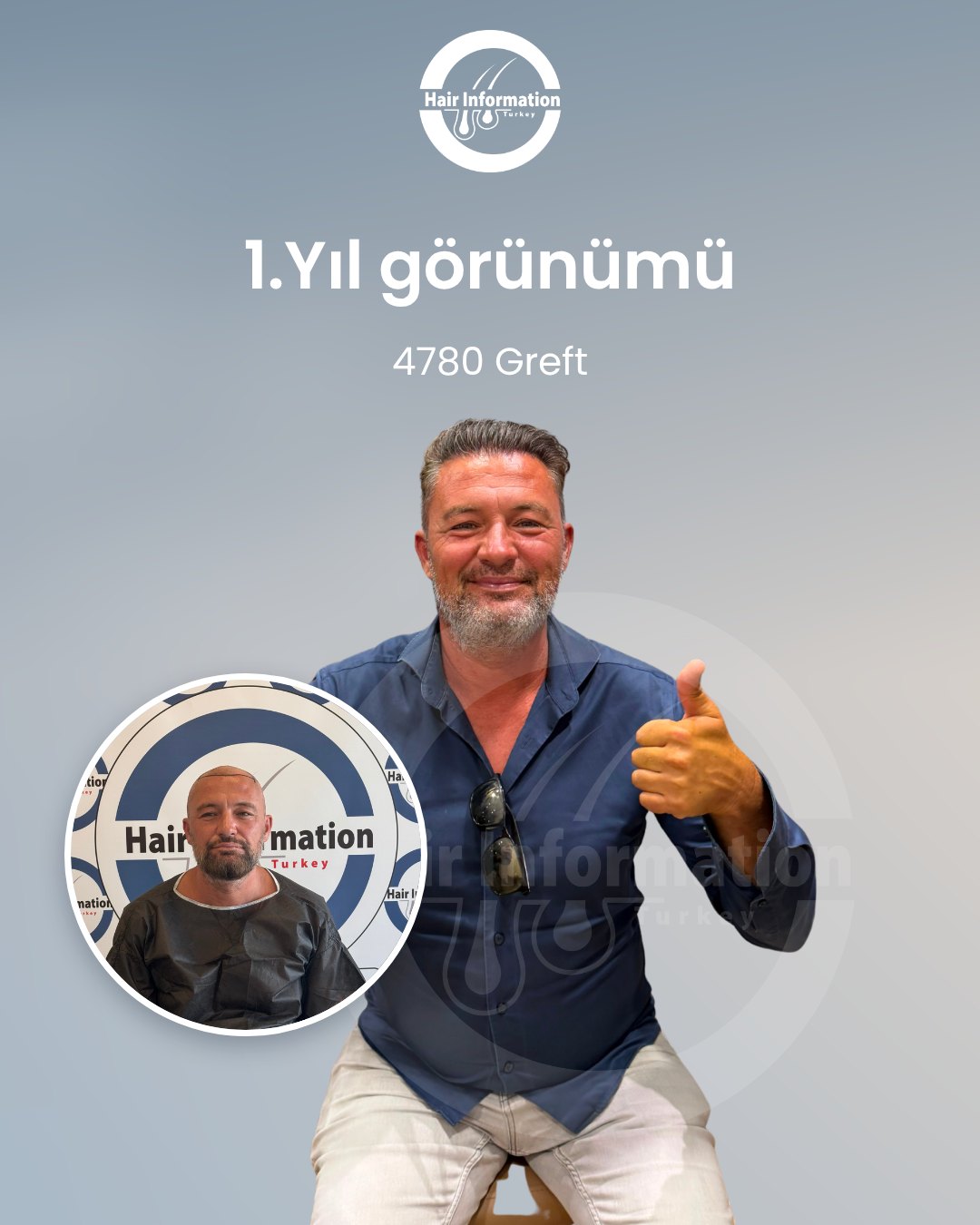 Saç ekimi öncesi ve sonrası – 1. yıl, 4.780 greft – Hair Information Clinic İzmir