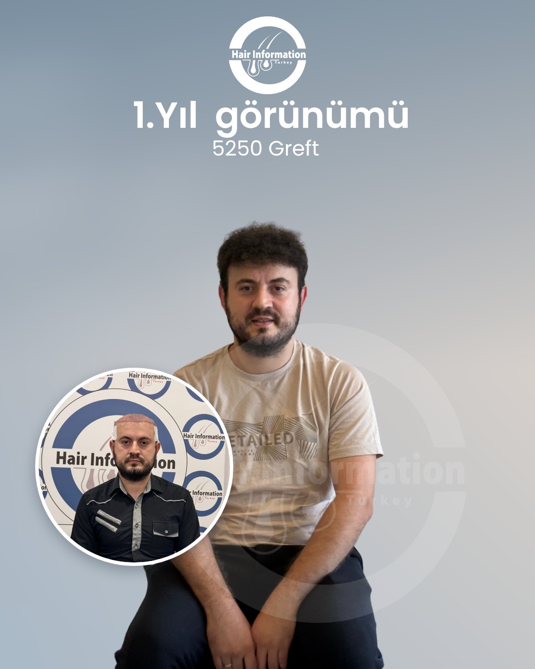 Saç ekimi öncesi ve sonrası – 1. yıl, 5.250 greft – Hair Information Clinic İzmir