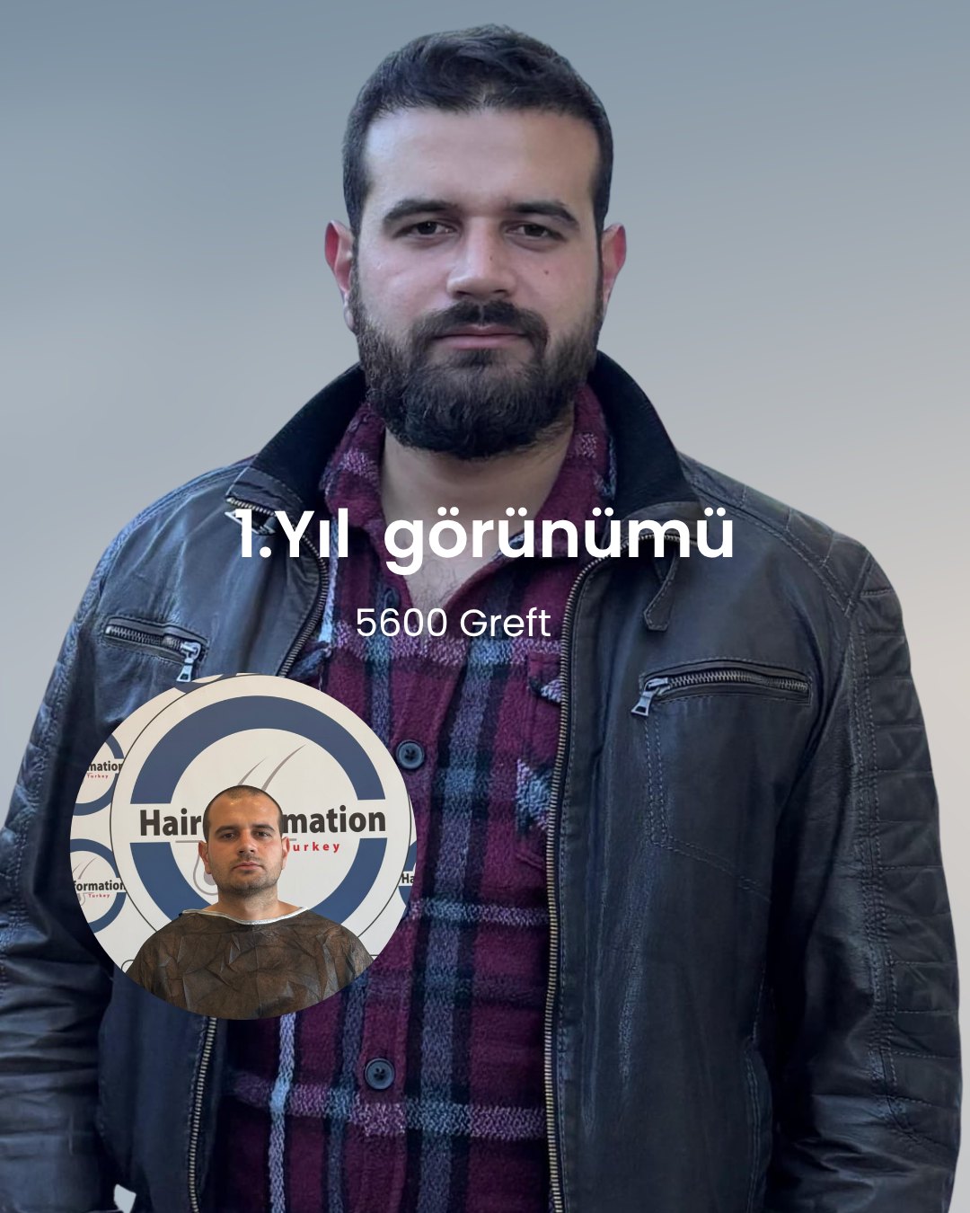 Saç ekimi öncesi ve sonrası – 1. yıl, 5.600 greft – Hair Information Clinic İzmir