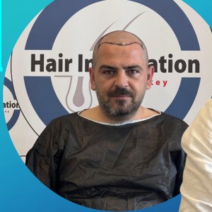 Saç ekimi öncesi
